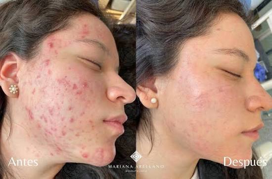 2 en 1 ClearBody™ Gel Limpiador Corporal Purificante | Elimina Granitos de Espalda, Pecho y Piel + 🎁 Guía "21 Secretos para una Piel Corporal Más Limpia" + Envío Gratis